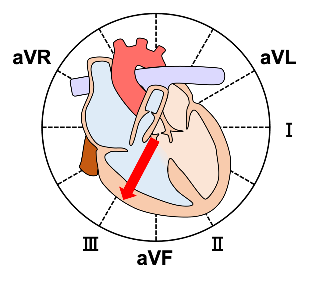 ファロー四徴症(Tetralogy of Fallot:TOF)