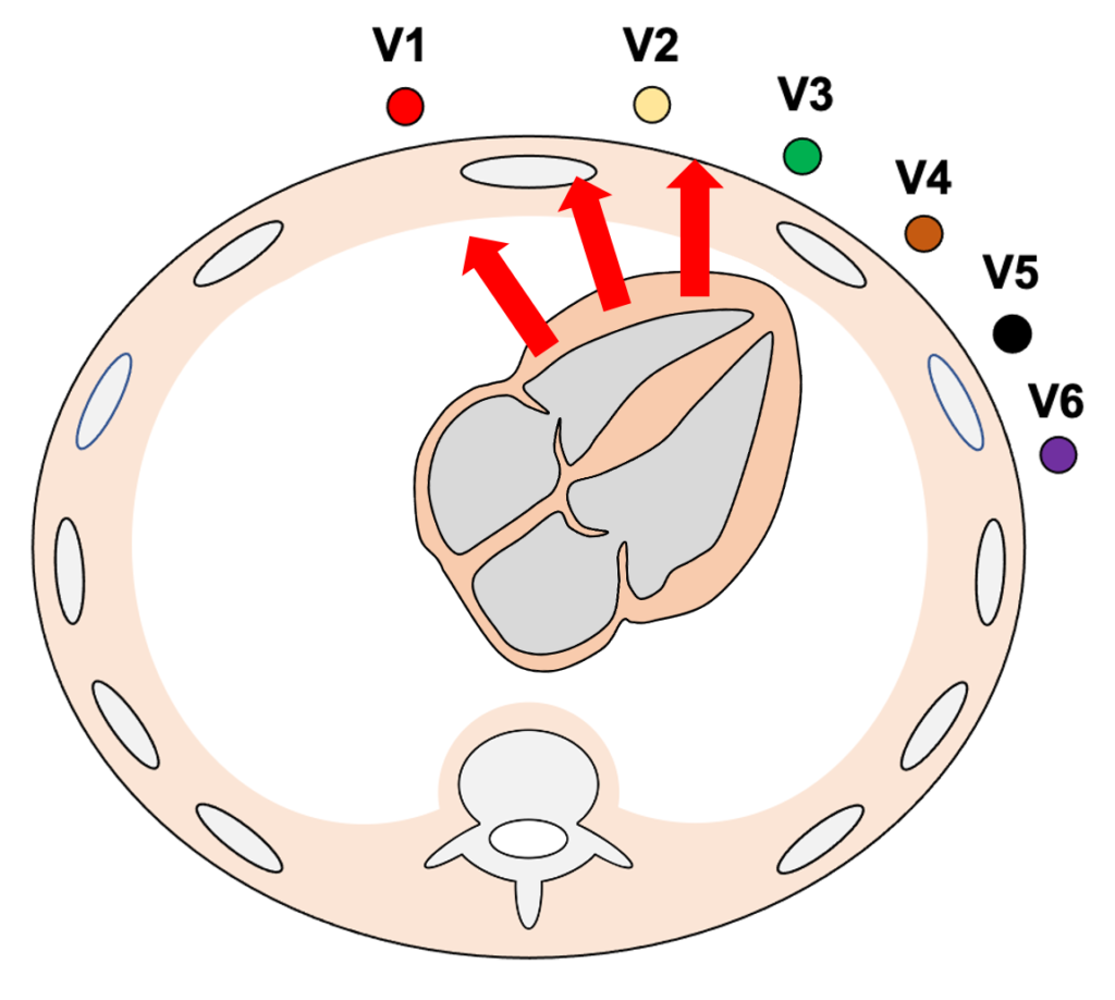 ファロー四徴症(Tetralogy of Fallot:TOF)