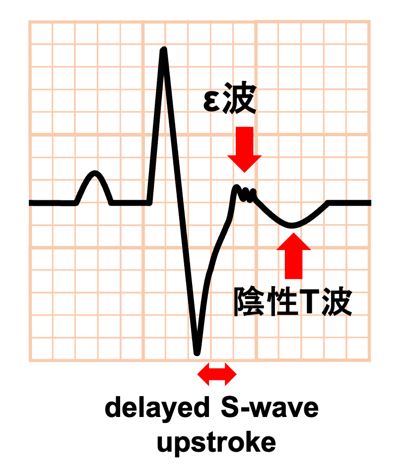 不整脈原性右室心筋症(arrhythmogenic right ventricular cardiomyopathy:ARVC)