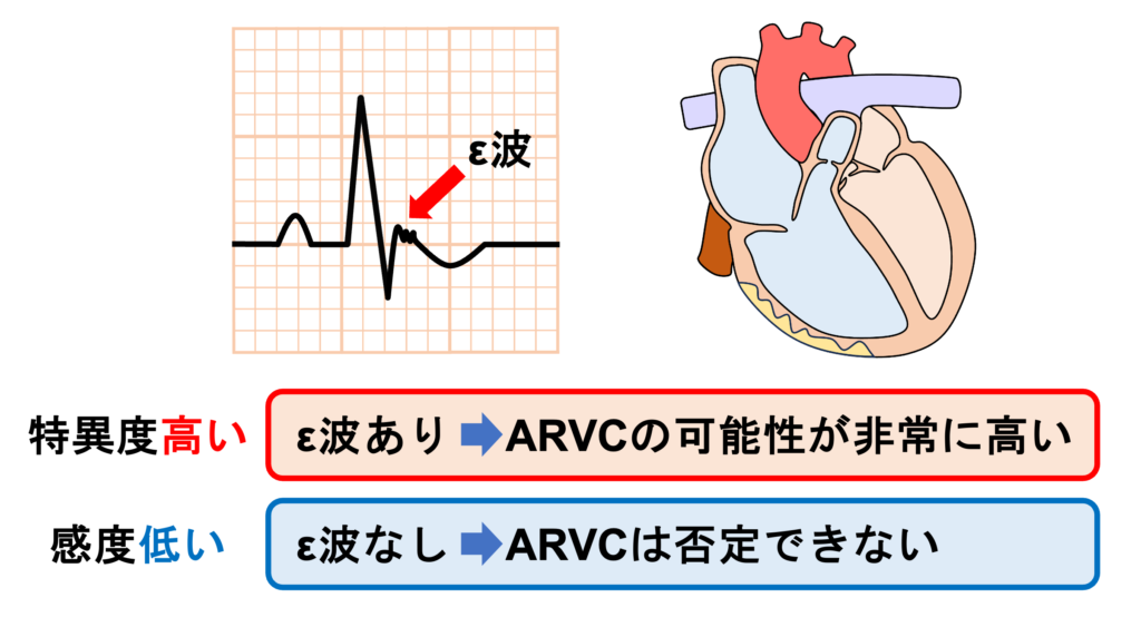 不整脈原性右室心筋症(arrhythmogenic right ventricular cardiomyopathy:ARVC)