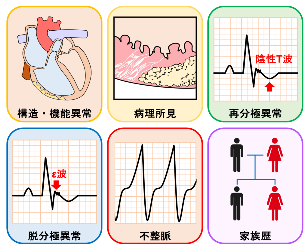 不整脈原性右室心筋症(arrhythmogenic right ventricular cardiomyopathy:ARVC)