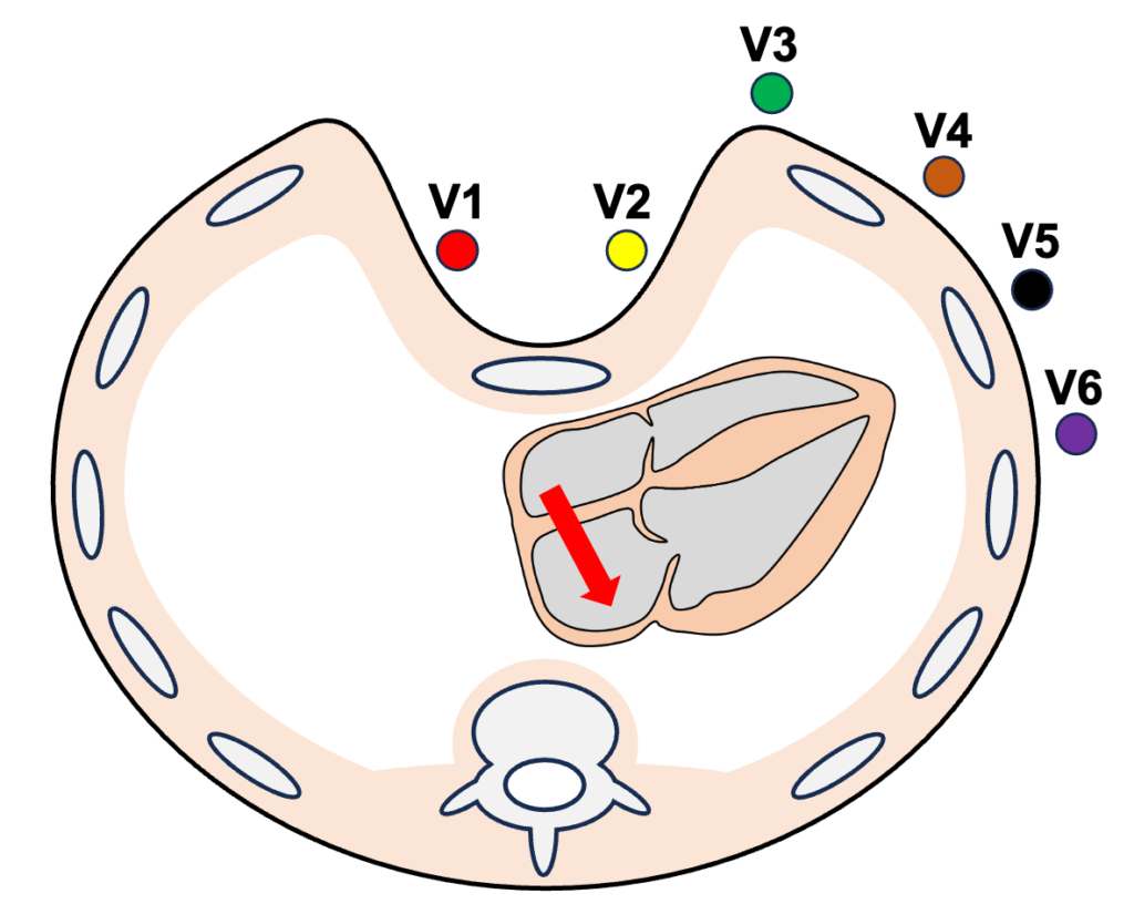 漏斗胸(pectus excavatum)