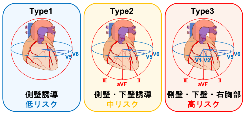 早期再分極症候群(early repolarization syndrome)