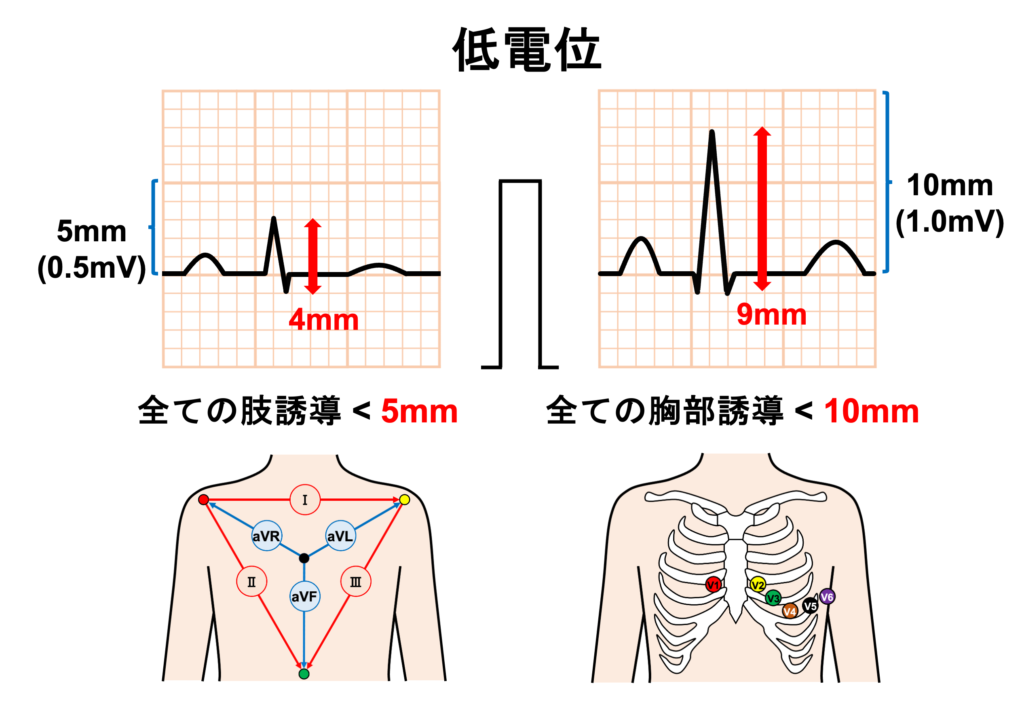 低電位(Low voltage)