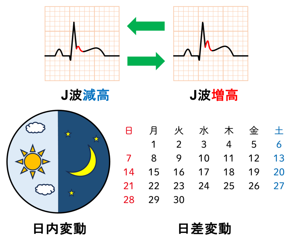 早期再分極症候群(early repolarization syndrome)