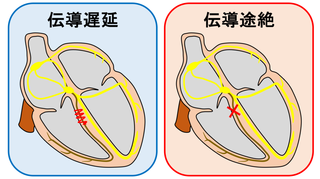 右脚ブロック(right bundle branch block：RBBB)