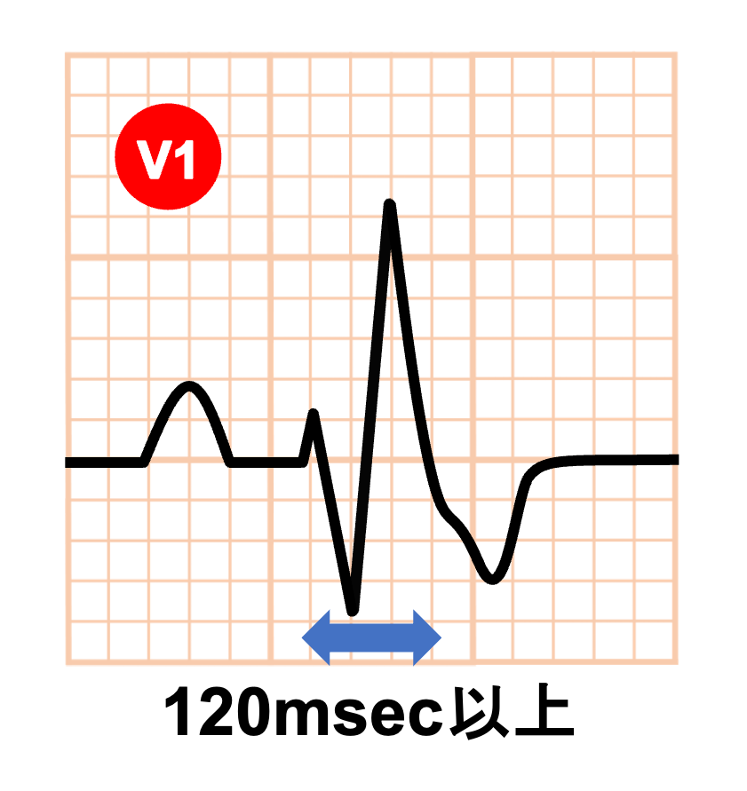 右脚ブロック(right bundle branch block：RBBB)