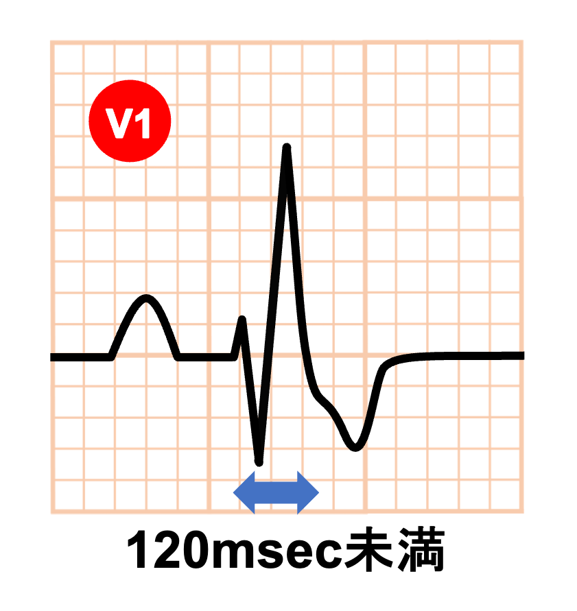 右脚ブロック(right bundle branch block：RBBB)