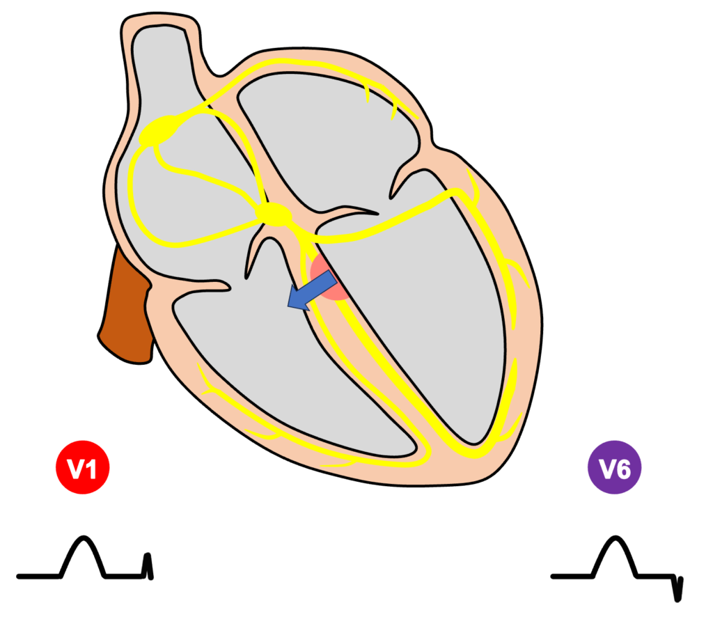 右脚ブロック(right bundle branch block：RBBB)
