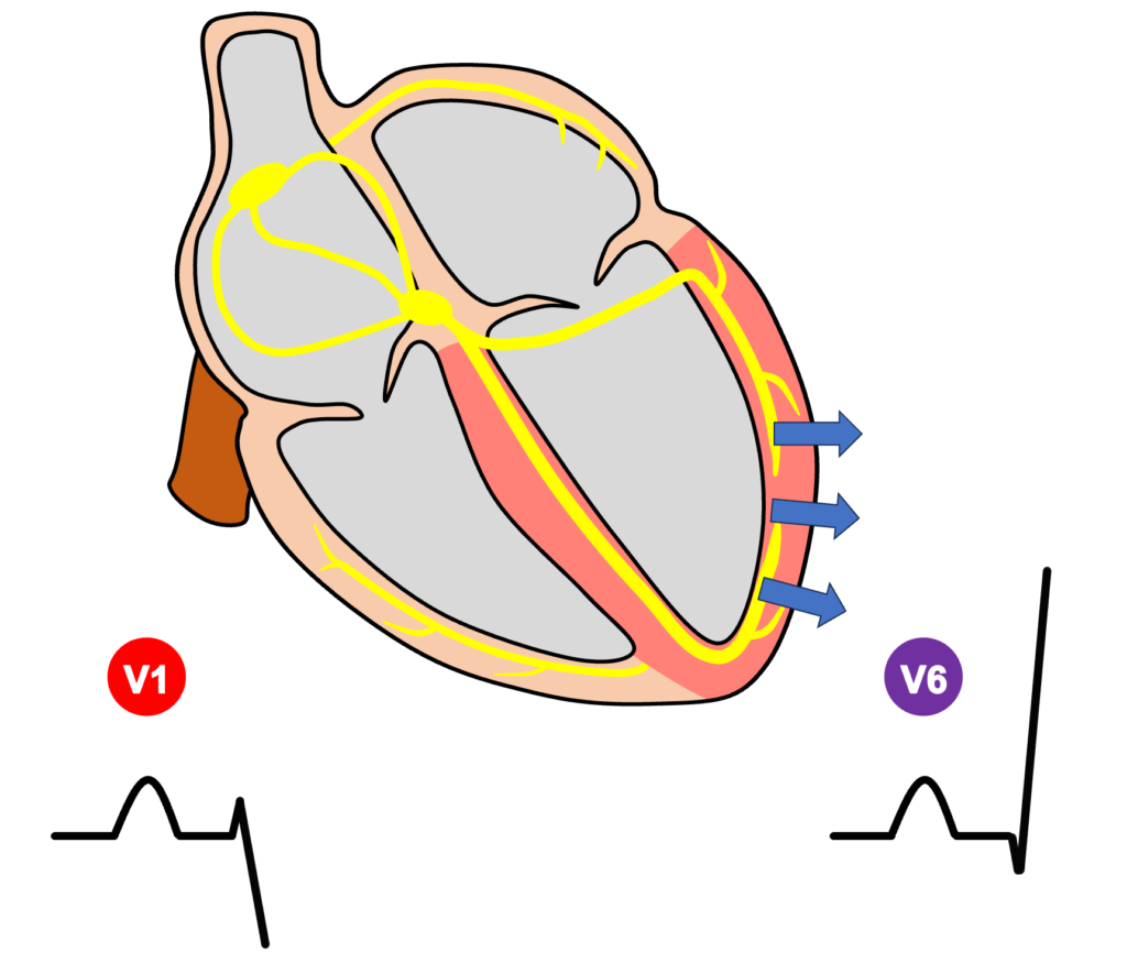右脚ブロック(right bundle branch block：RBBB)