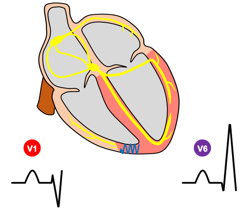 右脚ブロック(right bundle branch block：RBBB)