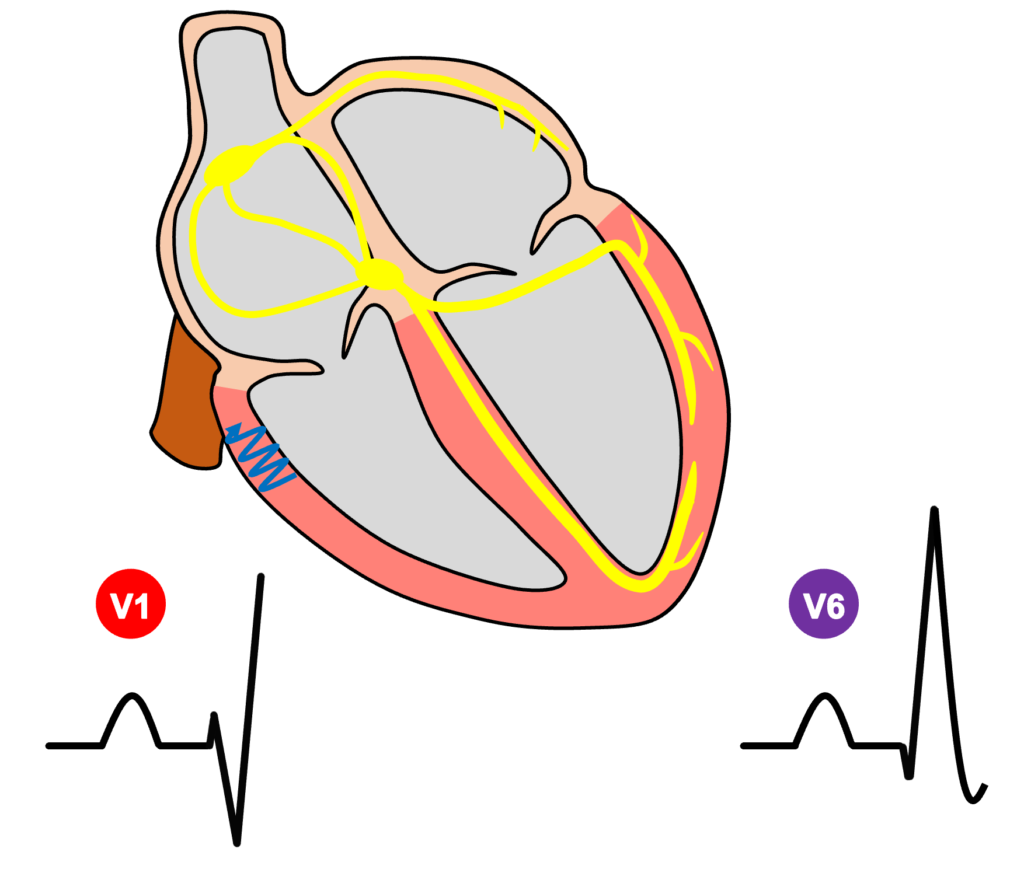 右脚ブロック(right bundle branch block：RBBB)