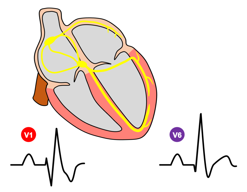 右脚ブロック(right bundle branch block：RBBB)