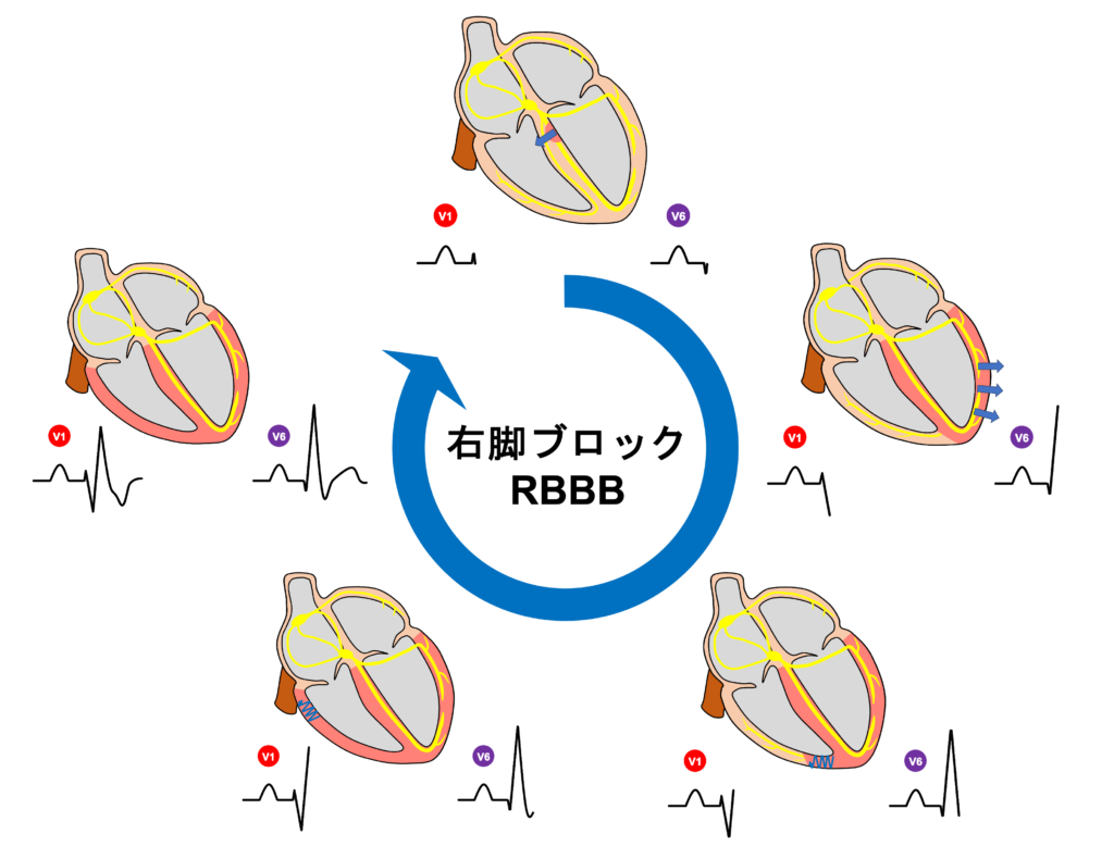 右脚ブロック(right bundle branch block：RBBB)