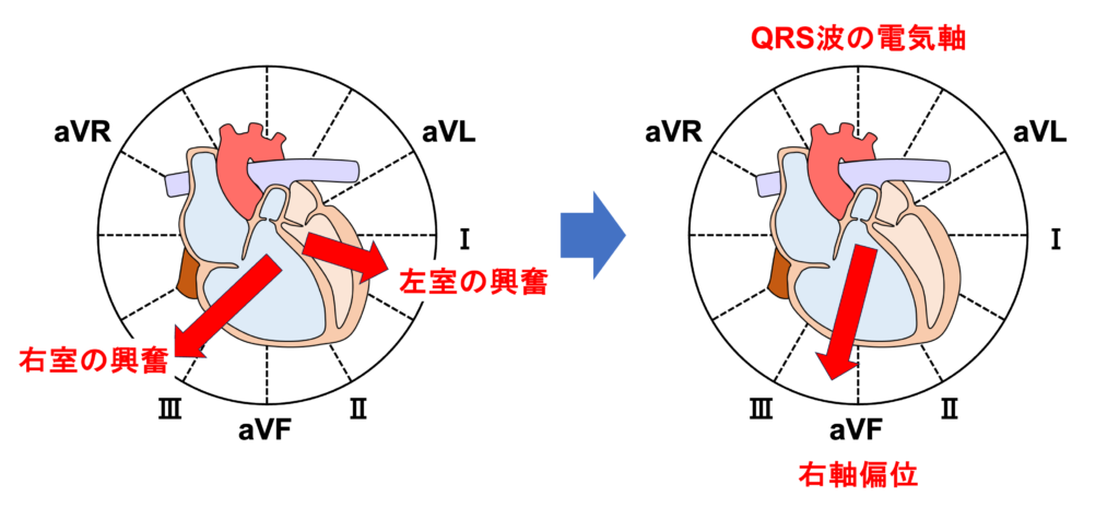 S1Q3T3 pattern