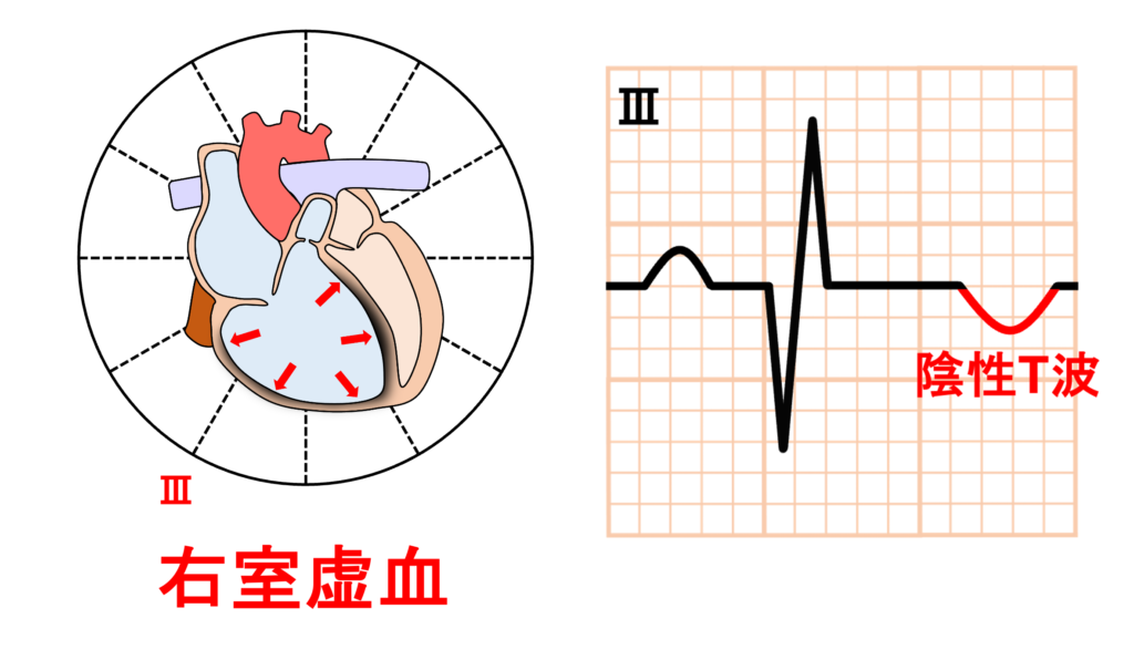 S1Q3T3 pattern
