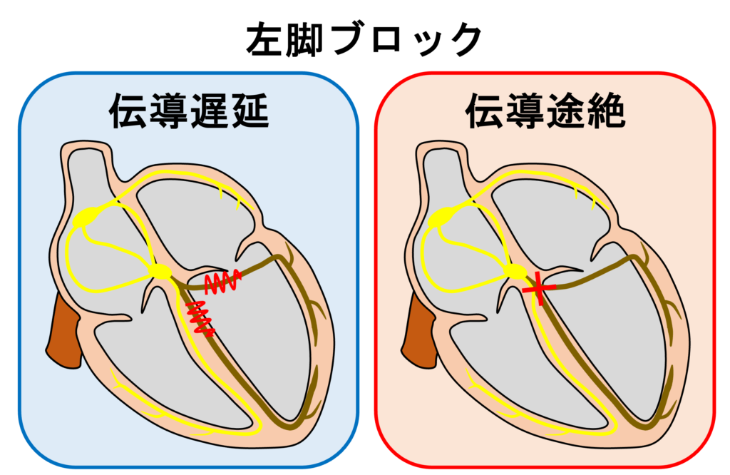 左脚ブロック(left bundle branch block)