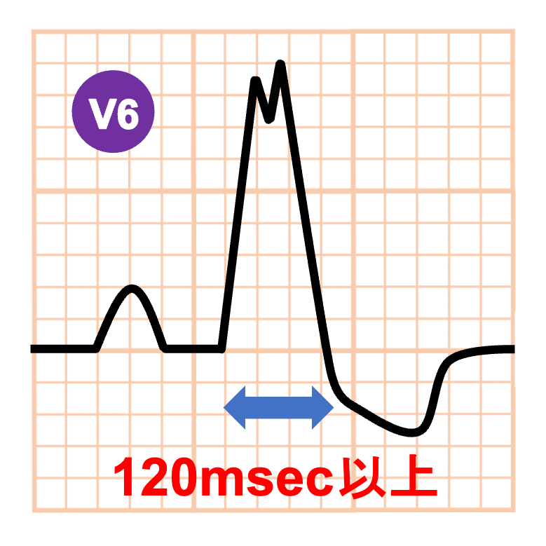 左脚ブロック(left bundle branch block)