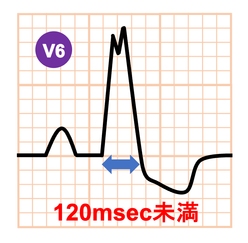 左脚ブロック(left bundle branch block)