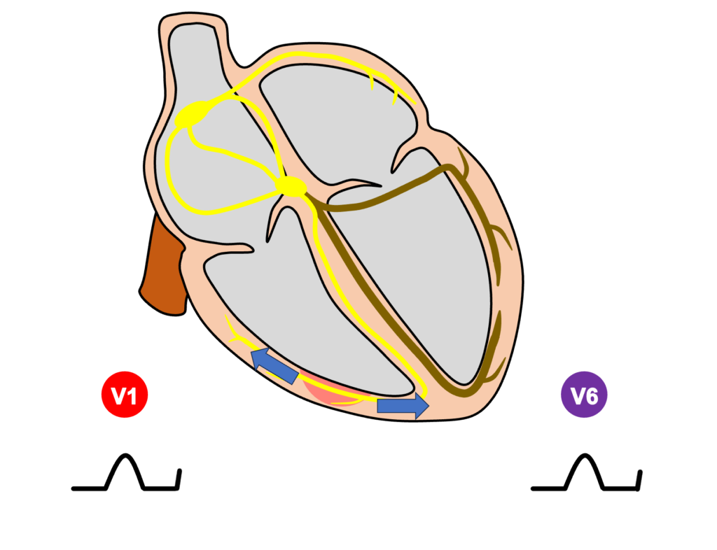 左脚ブロック(left bundle branch block)