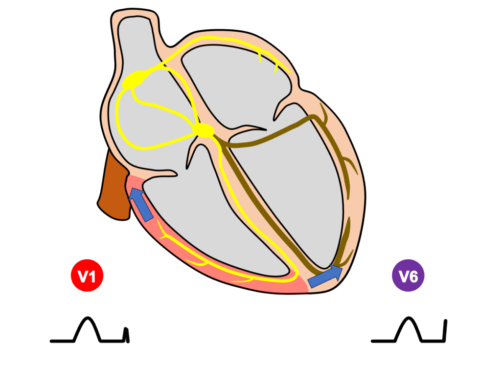 左脚ブロック(left bundle branch block)