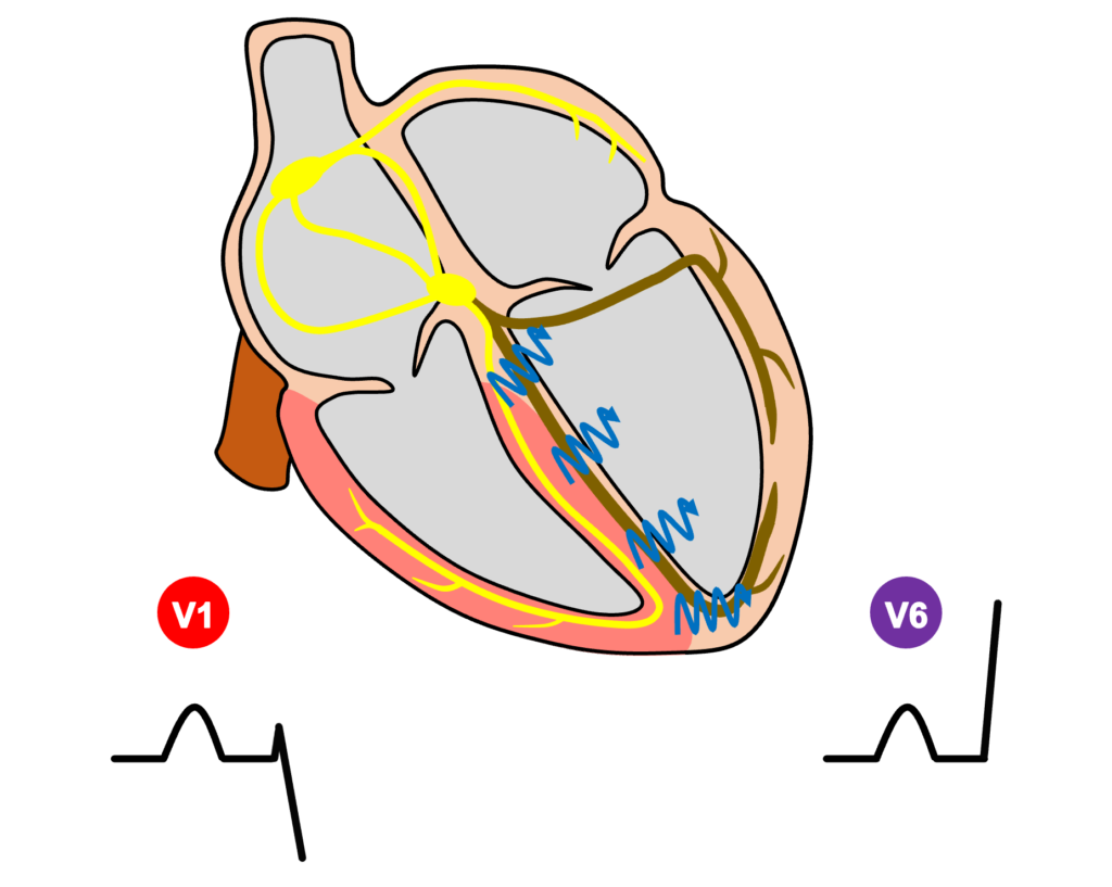 左脚ブロック(left bundle branch block)