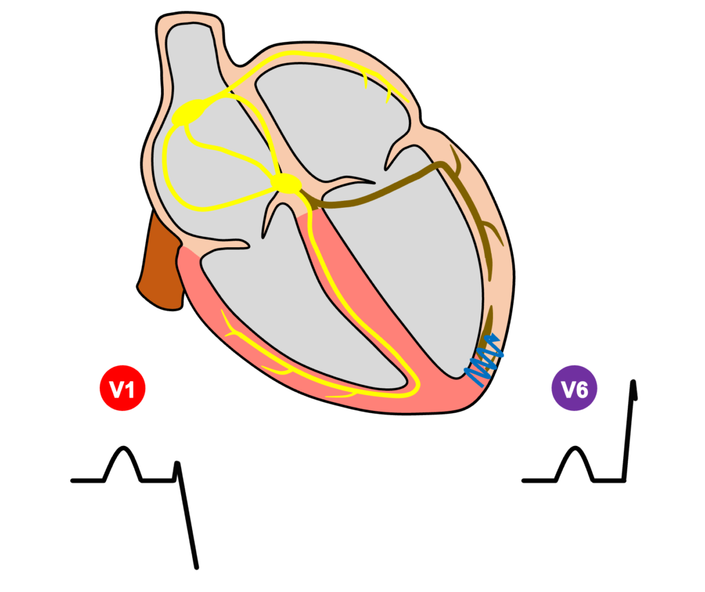 左脚ブロック(left bundle branch block)