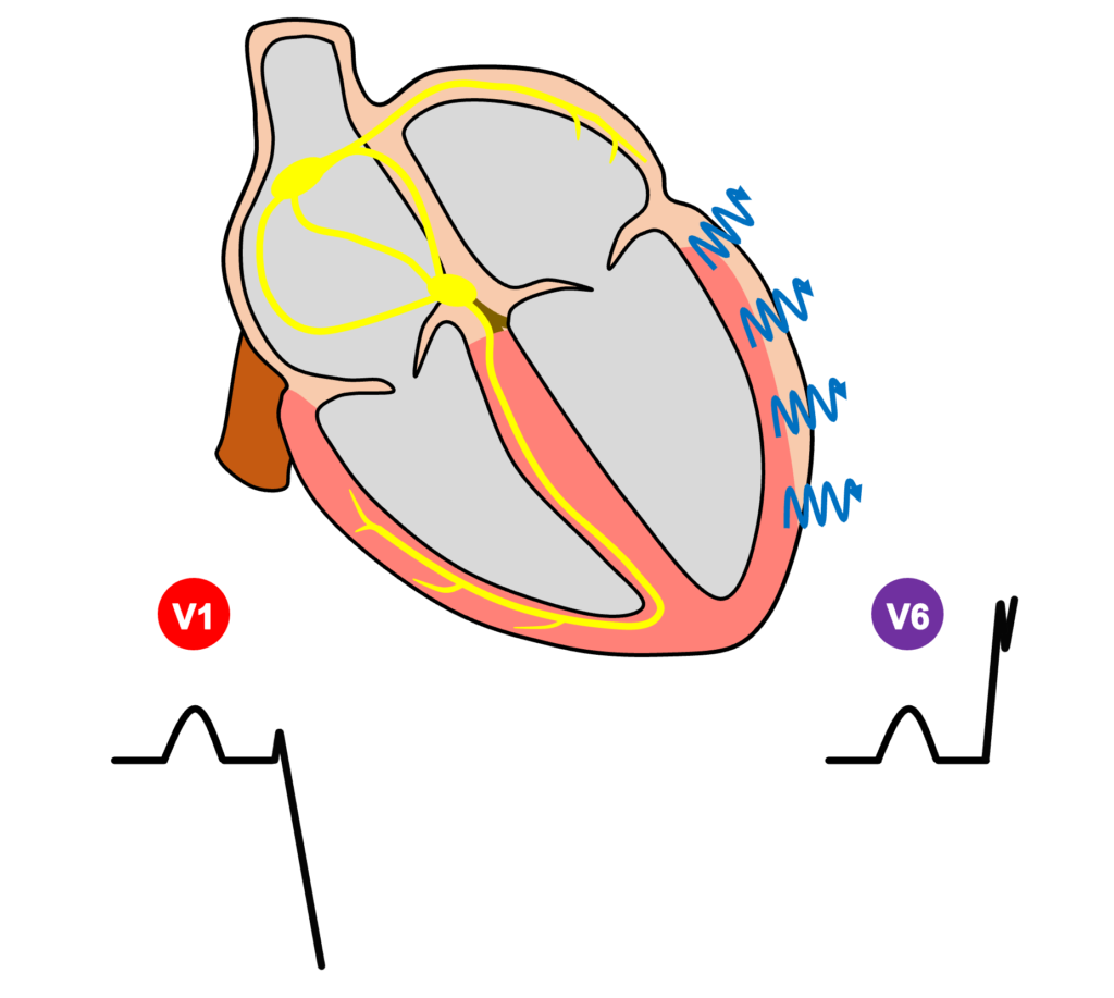 左脚ブロック(left bundle branch block)