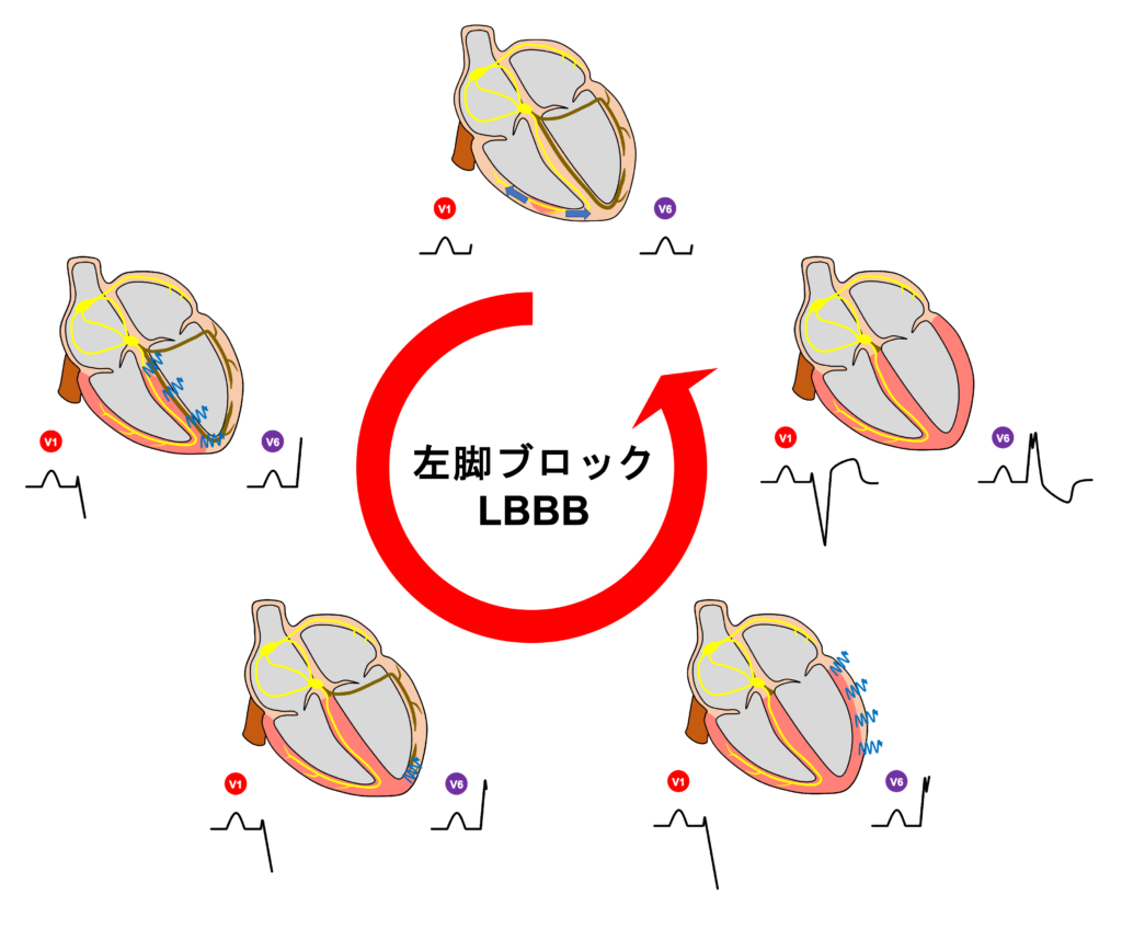 左脚ブロック(left bundle branch block)