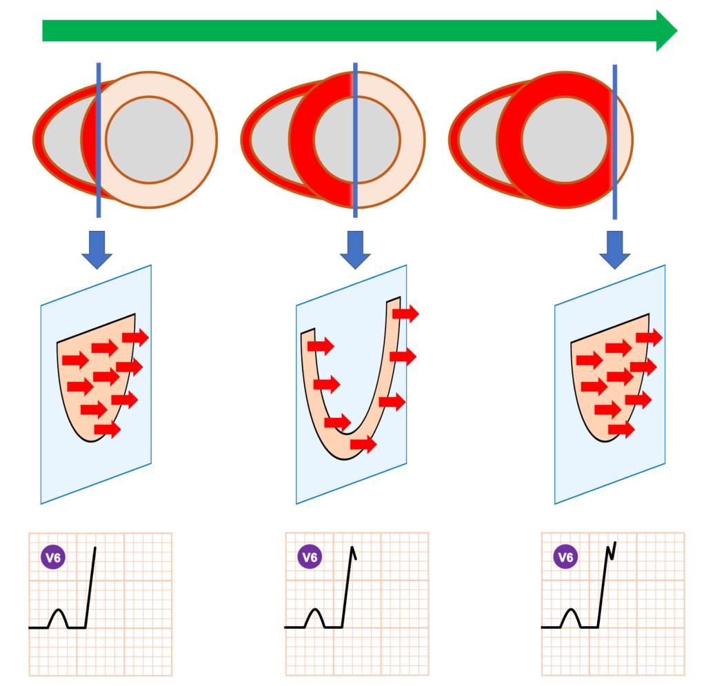左脚ブロック(left bundle branch block)