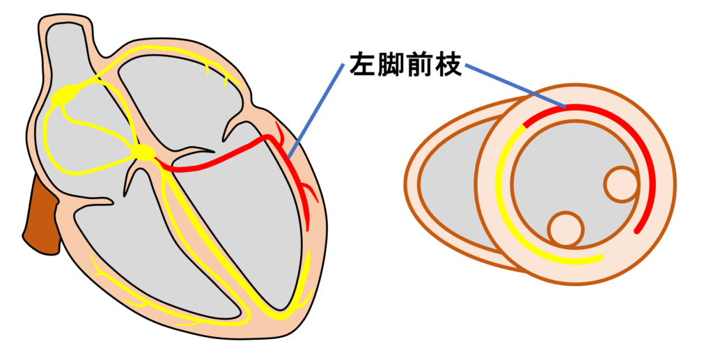 左脚前枝ブロック(left anterior fascicle block)