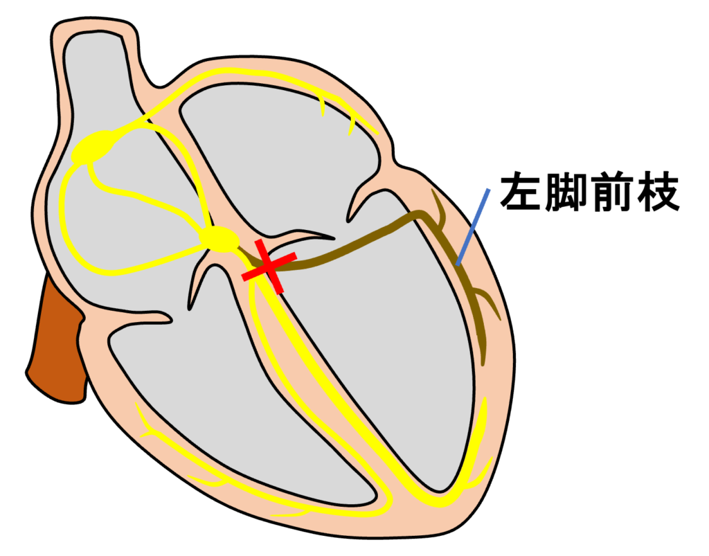 左脚前枝ブロック(left anterior fascicle block)