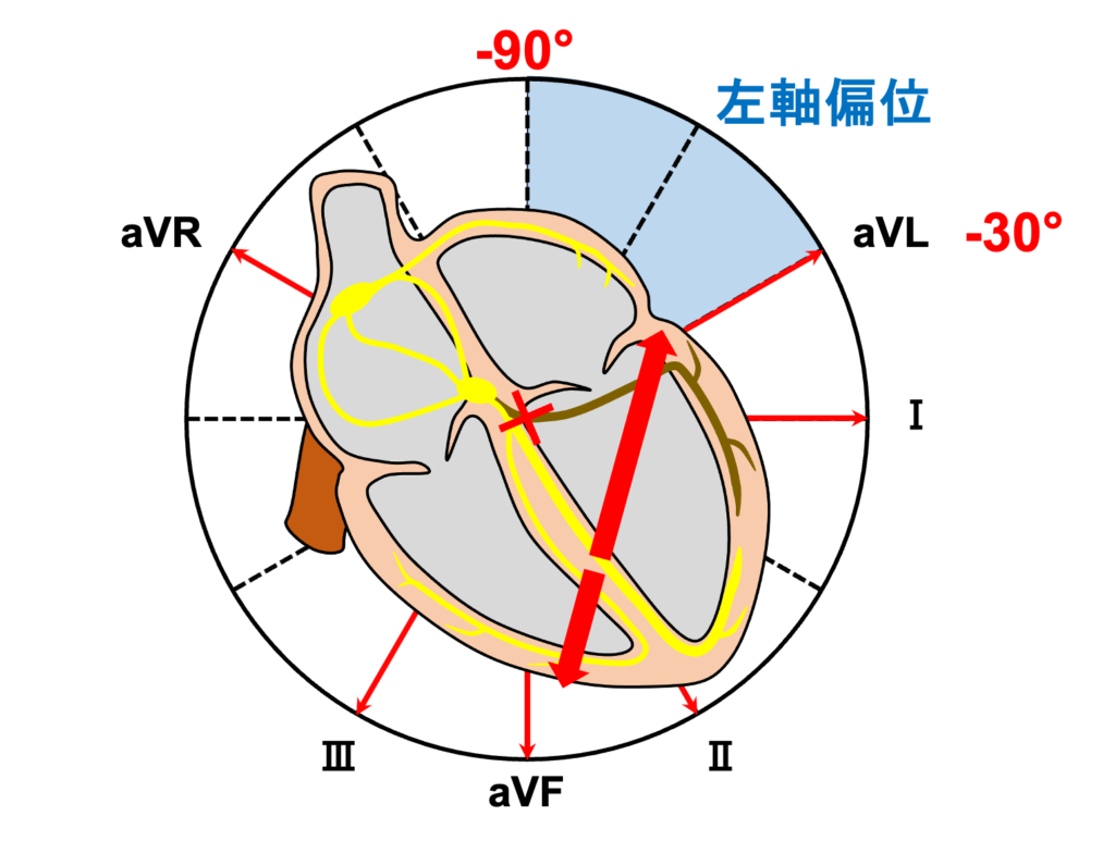 左脚前枝ブロック(left anterior fascicle block)