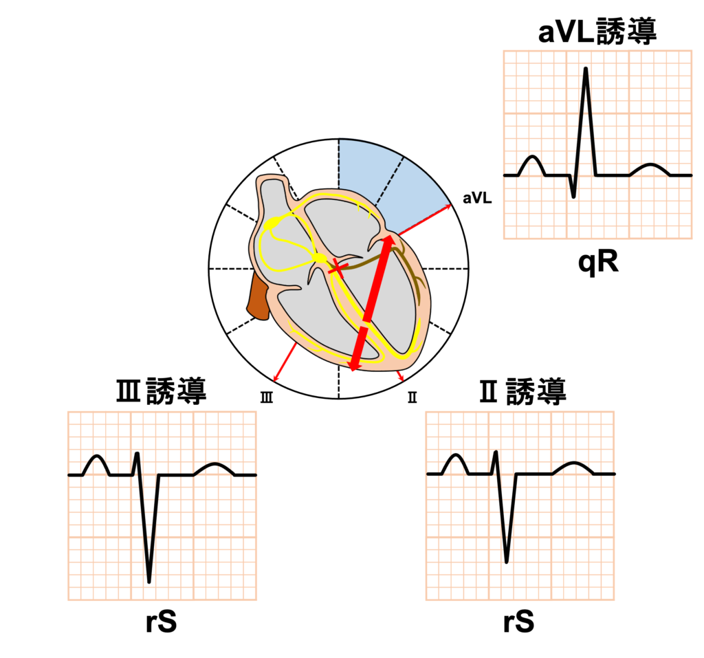 左脚前枝ブロック(left anterior fascicle block)