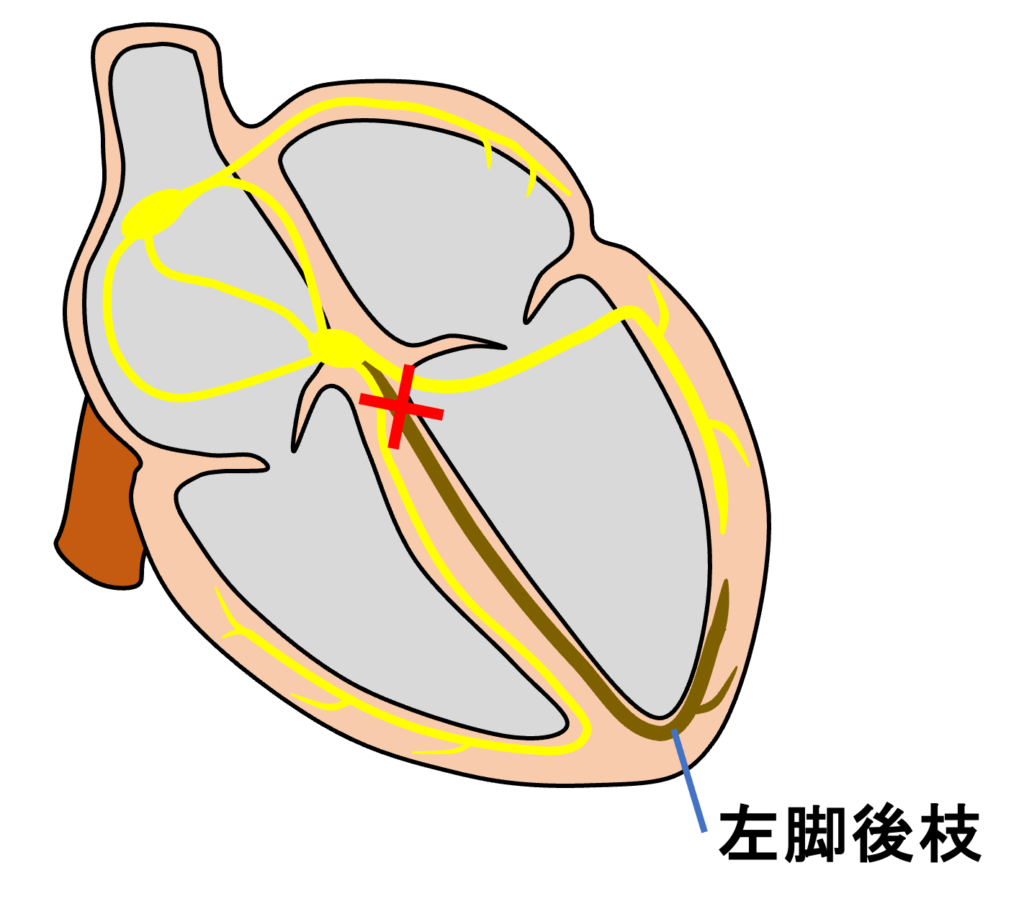 左脚後枝ブロック(left posterior fascicular block:LPFB)