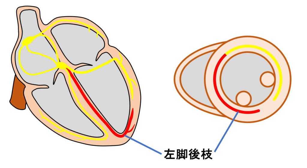 左脚後枝ブロック(left posterior fascicular block:LPFB)