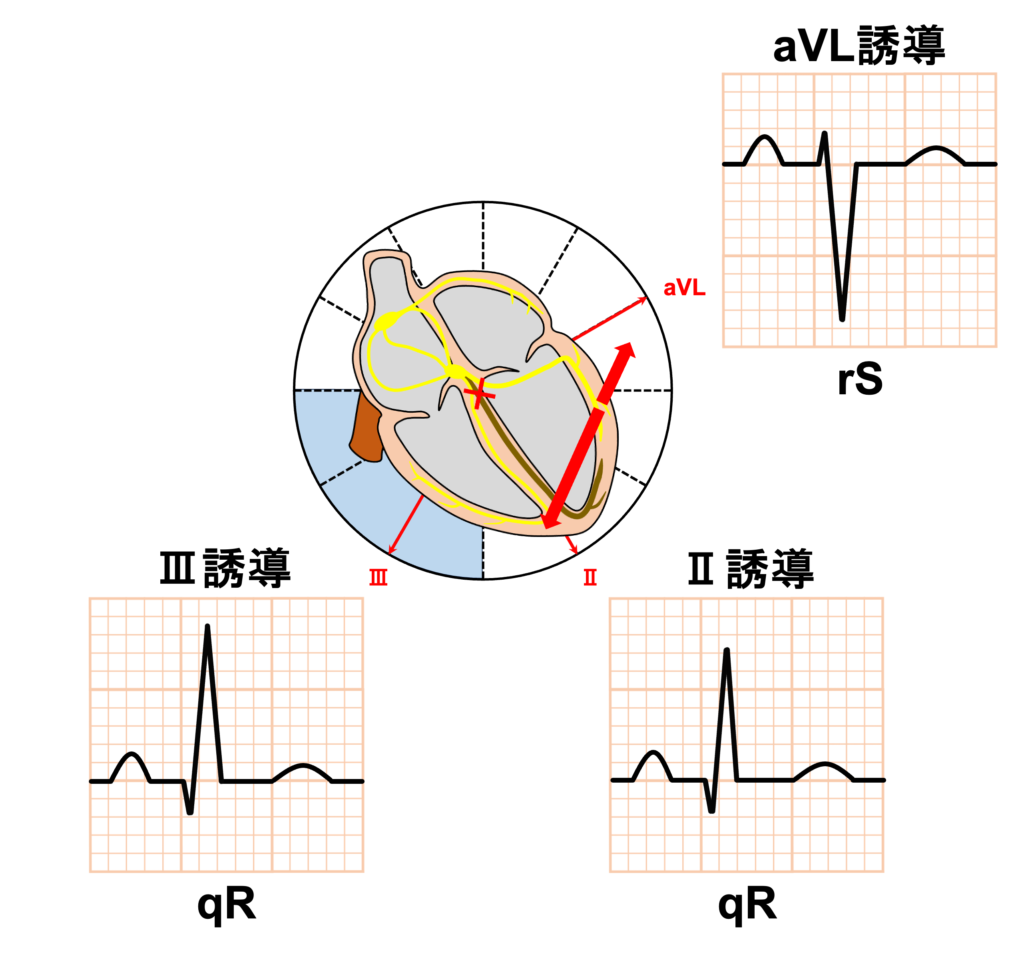 左脚後枝ブロック(left posterior fascicular block:LPFB)