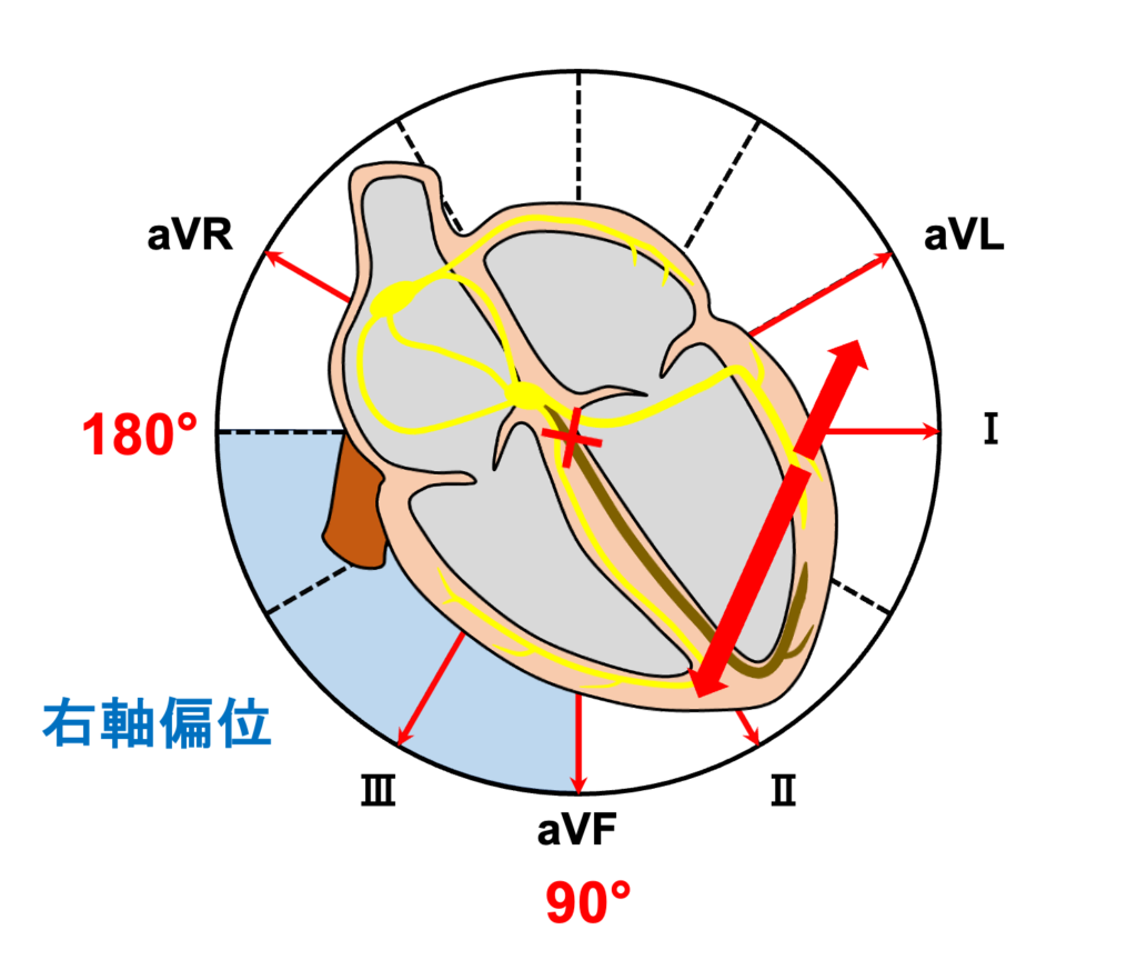 左脚後枝ブロック(left posterior fascicular block:LPFB)