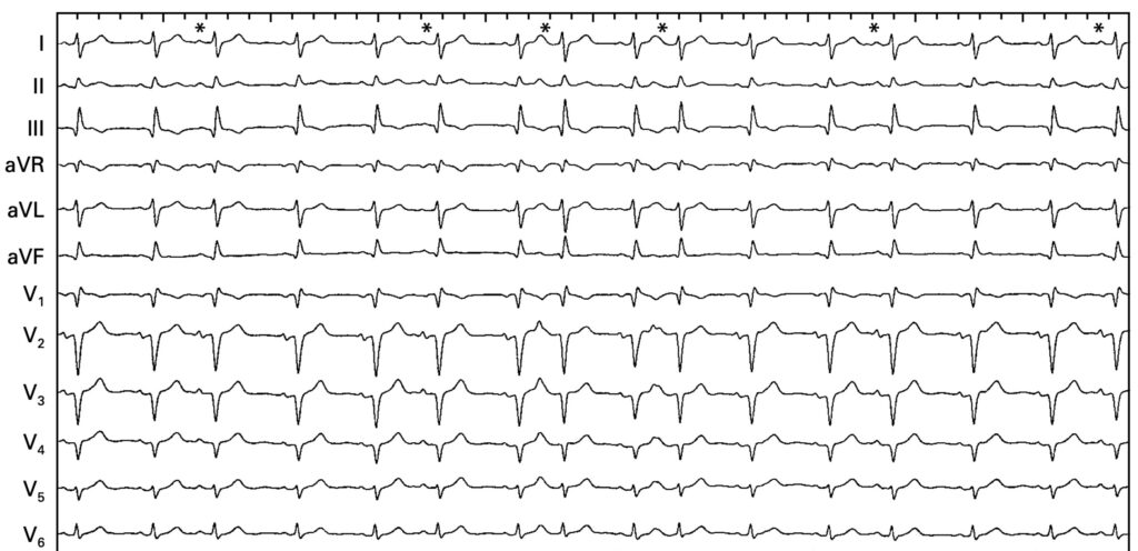 心房副収縮(atrial parasystole)