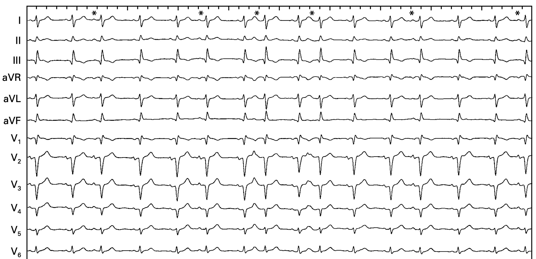 心房副収縮(atrial parasystole)