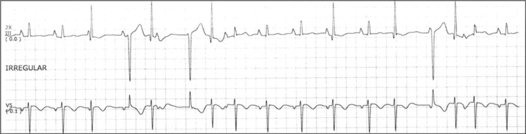 double ventricular parasystole重複副収縮
