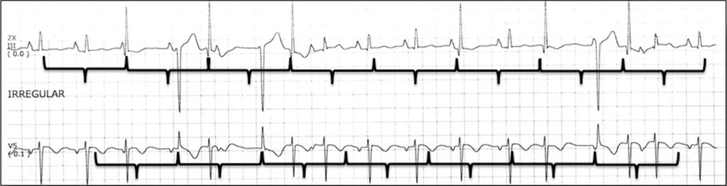 double ventricular parasystole重複副収縮