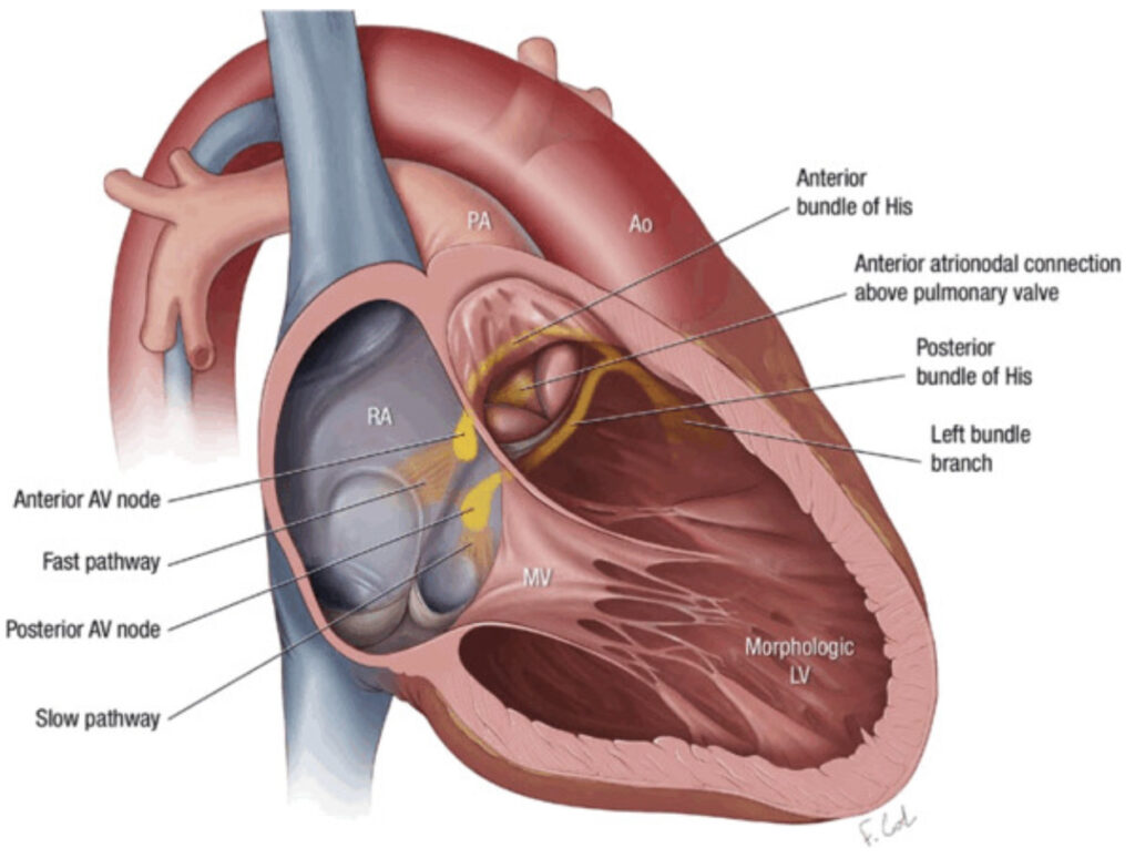 修正大血管転位症(corrected transposition of great arteries)