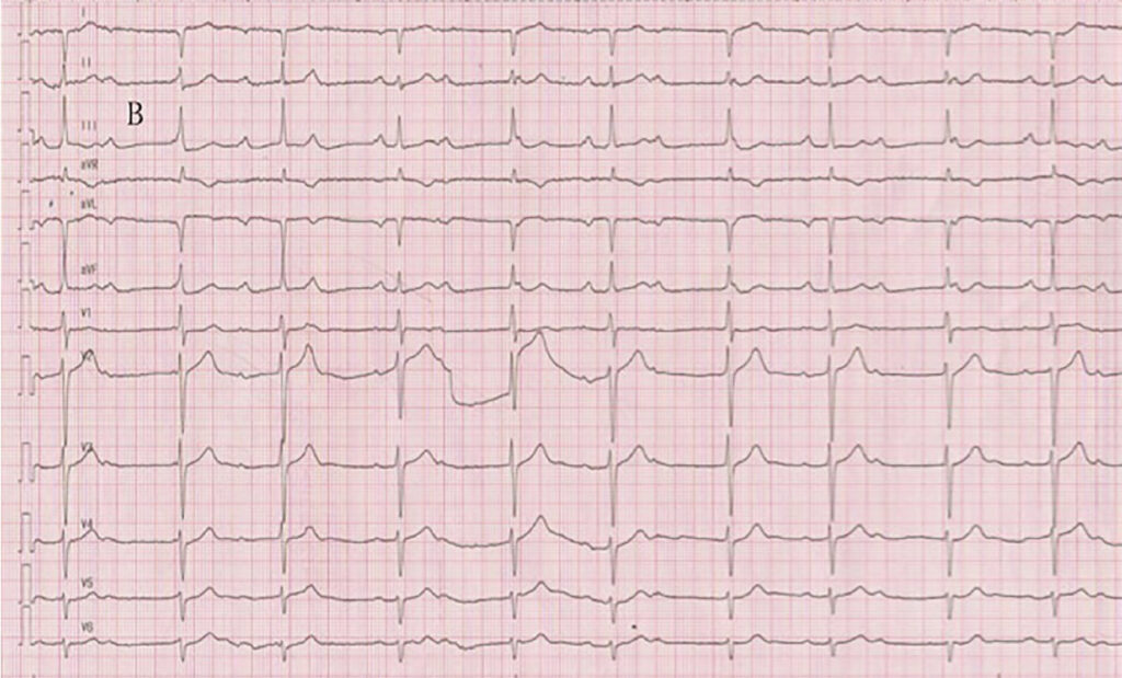修正大血管転位症(corrected transposition of great arteries)