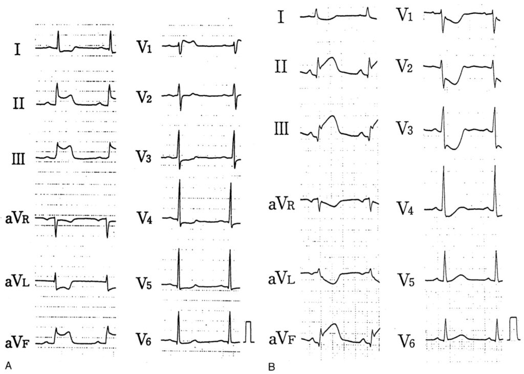 下壁心筋梗塞(inferior myocardial infarction)