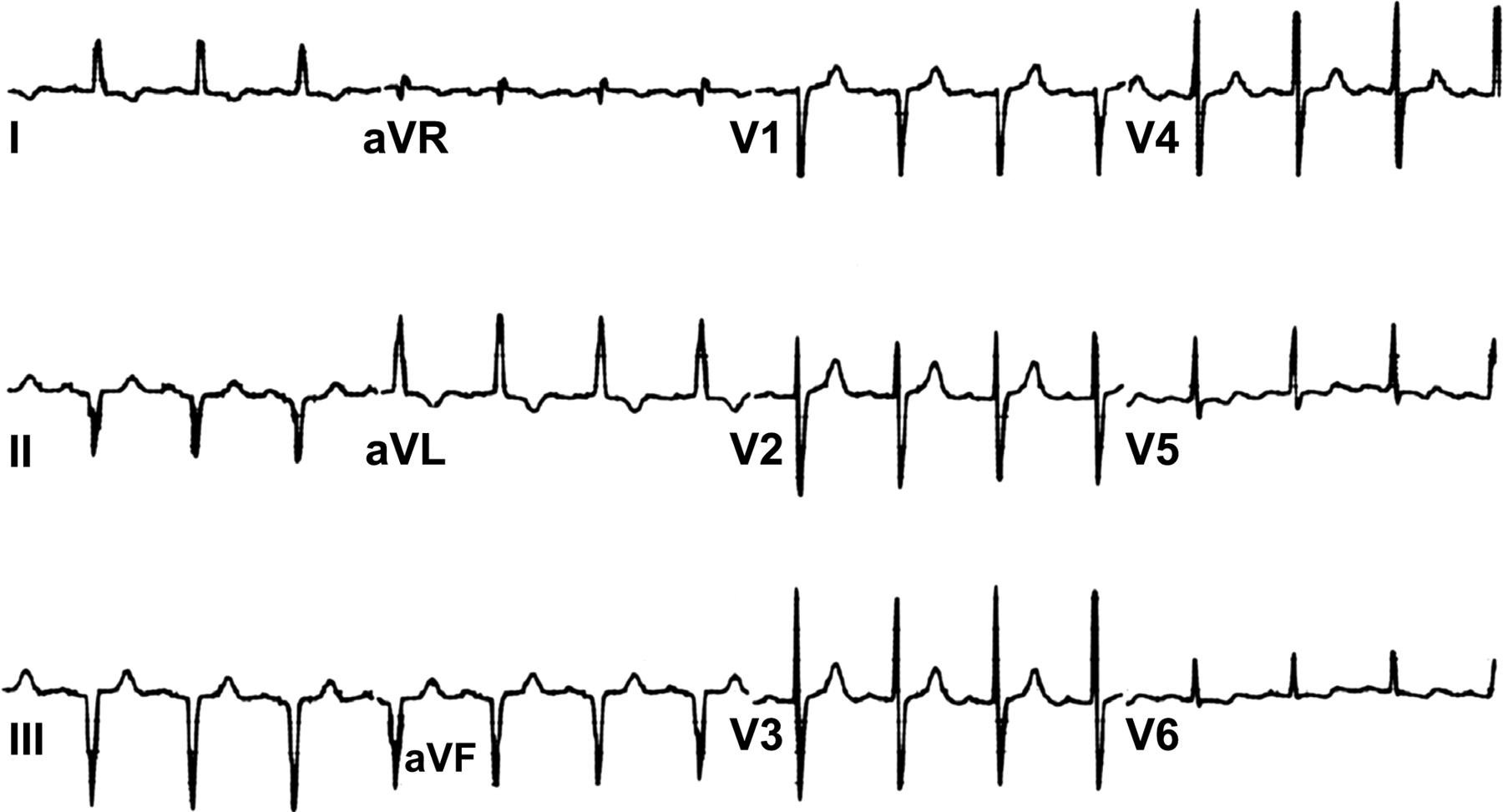 修正大血管転位症(corrected transposition of great arteries)
