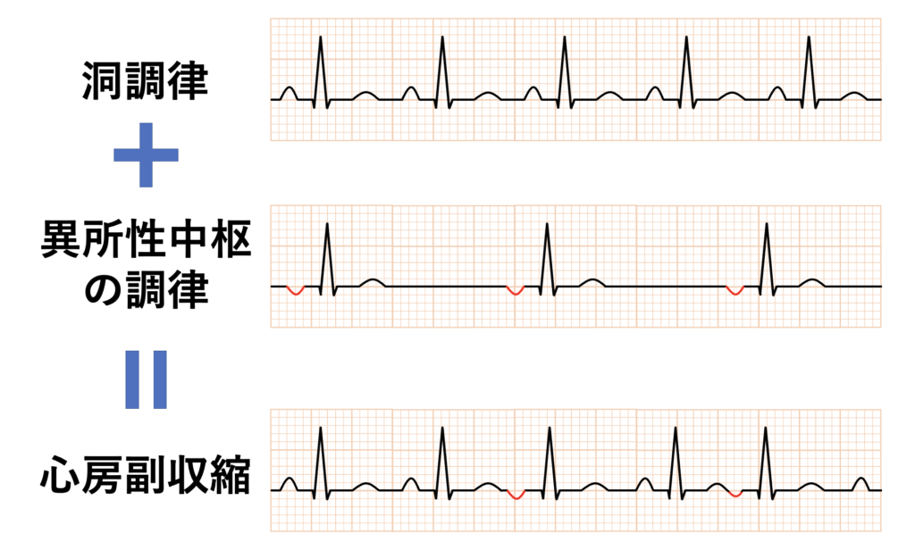 心房副収縮(atrial parasystole)