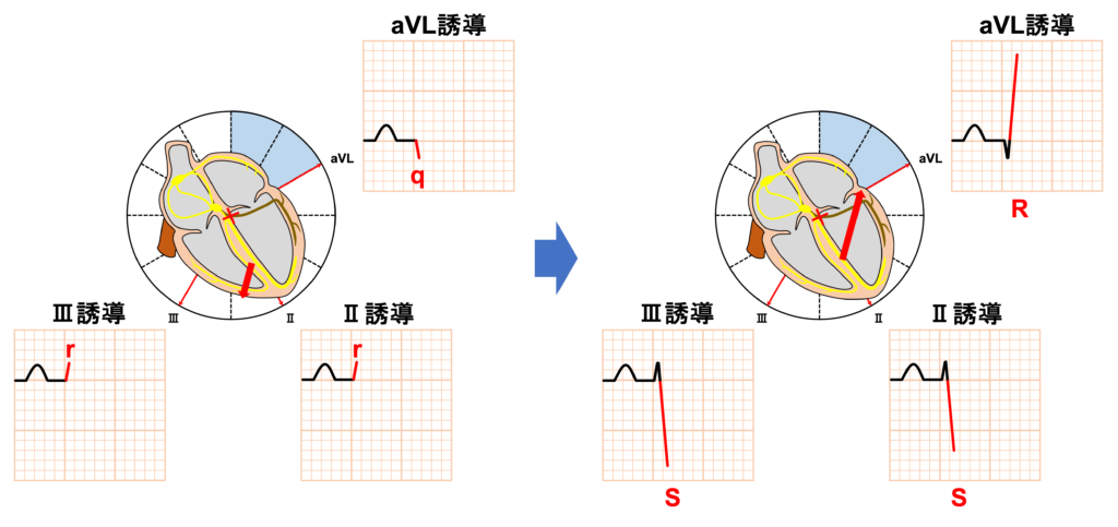 左脚前枝ブロック(left anterior fascicle block)