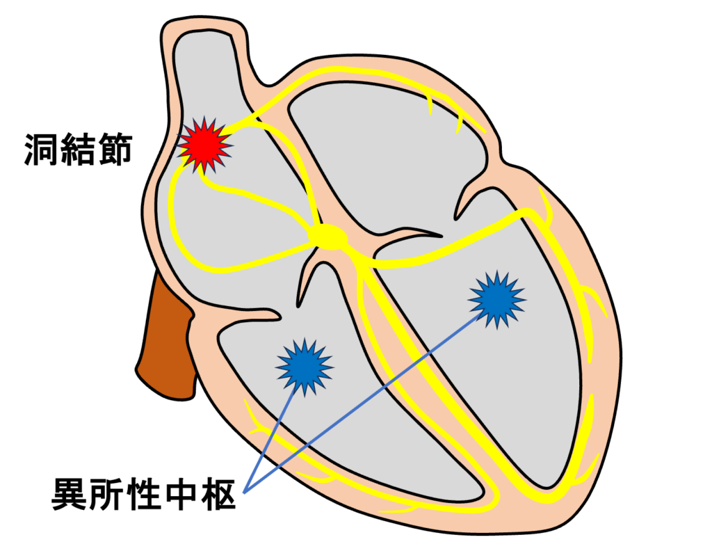 double ventricular parasystole重複副収縮