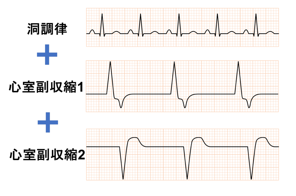 double ventricular parasystole重複副収縮
